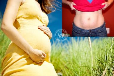 Post Pregnancy Stretch Marks - a worrisome issue for expecting mothers! Post Pregnancy Stretch Marks - a worrisome issue for expecting mothers},{Post Pregnancy Stretch Marks - a worrisome issue for expecting mothers