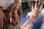 fashion and beauty, how to get rid of black henna scars, henna tattoo cause aussie woman to almost lose her hand, Tattoo