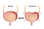 Overactive Bladder foods, Overactive Bladder disadvantages, here are some warning signs of an overactive bladder, Urinating