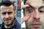 who cannot wear contact lenses, contact lens safety, contact lens wearers beware man goes blind after parasites eat man s eye as he wore lenses in shower, Contact lens