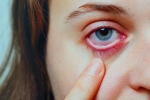 Conjunctivitis treatment, Conjunctivitis Telangana, special measures to prevent conjunctivitis, Conjunctivitis