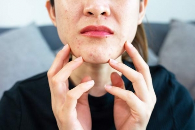 Does your Regular Routine cause you Acne?