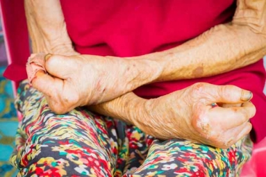 World Leprosy Day 2019: Essential Facts About Curable Disease World Leprosy Day 2019: Essential Facts About Curable Disease