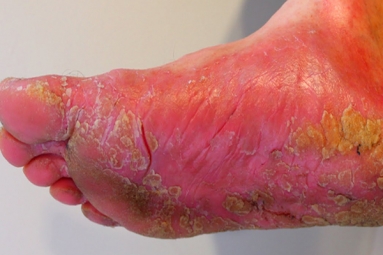 Top 7 Home Remedies for Athlete's Foot