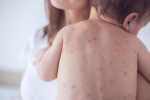 measles in adults, measles in US, measles back in the united states as children omit vaccination doses, Toddler